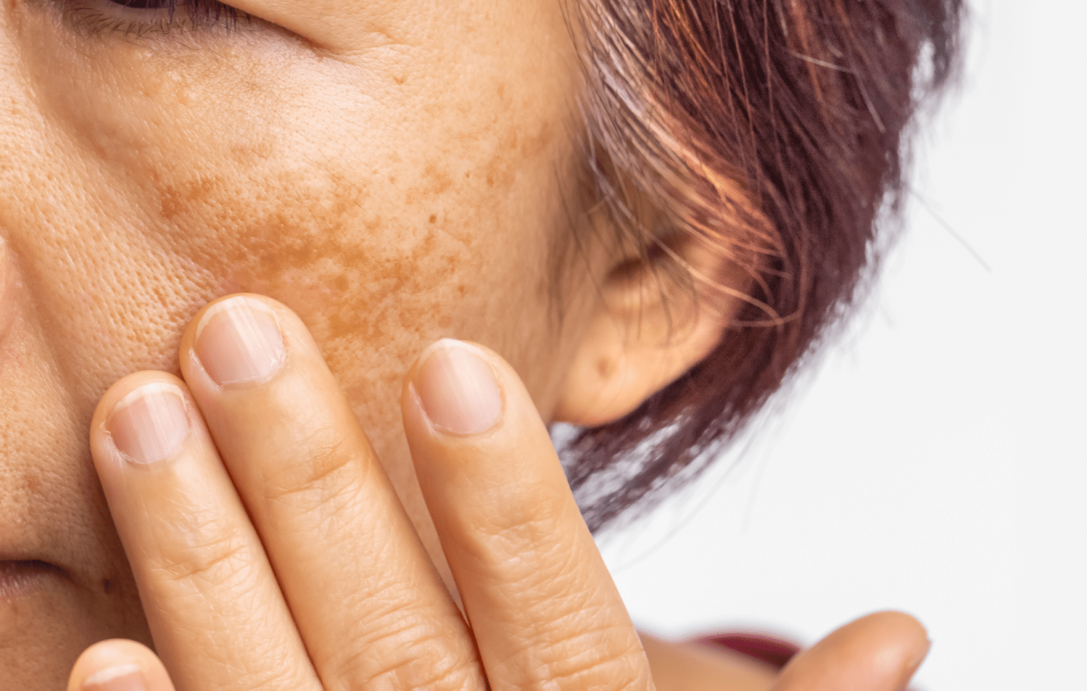 Featured image for post: Understanding Melasma: Your Guide to Clearer, Brighter Skin